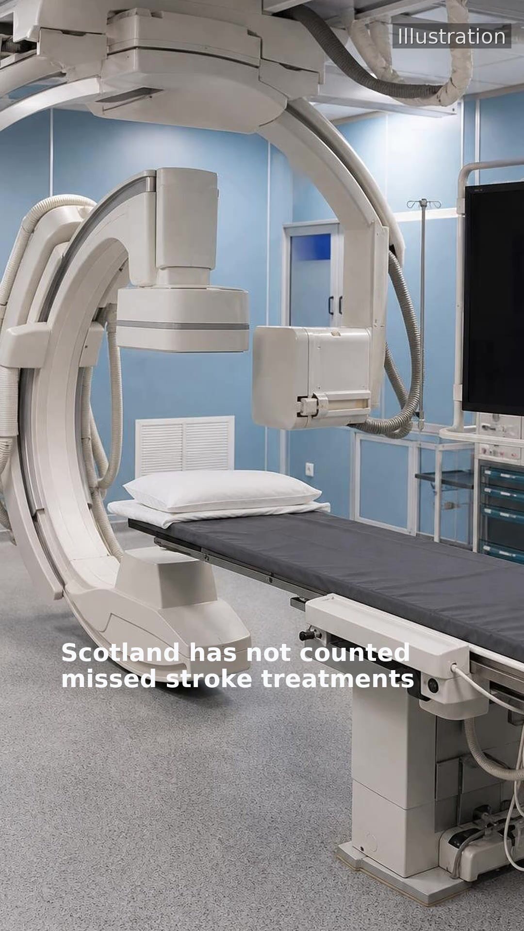 Scotland has not counted missed stroke treatments