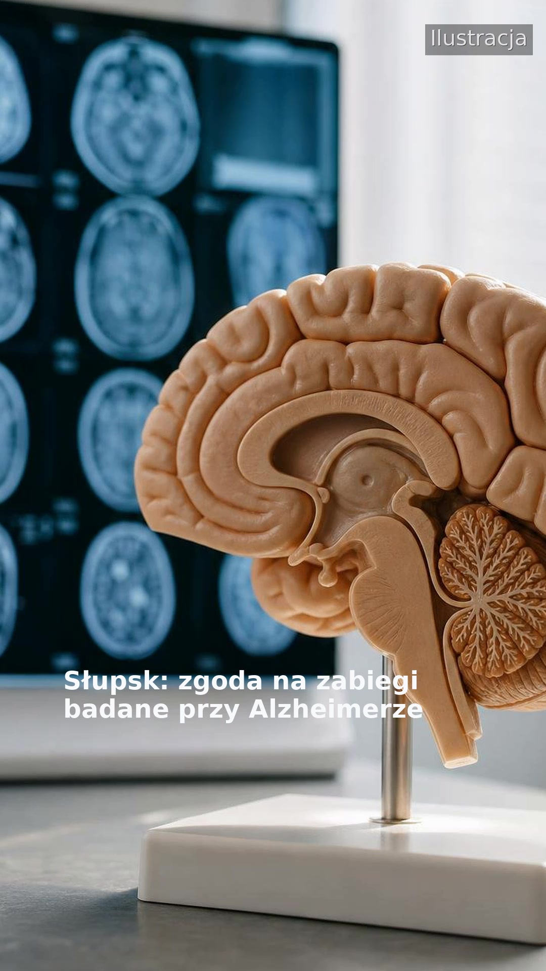 Słupsk: zgoda na zabiegi badane przy Alzheimerze