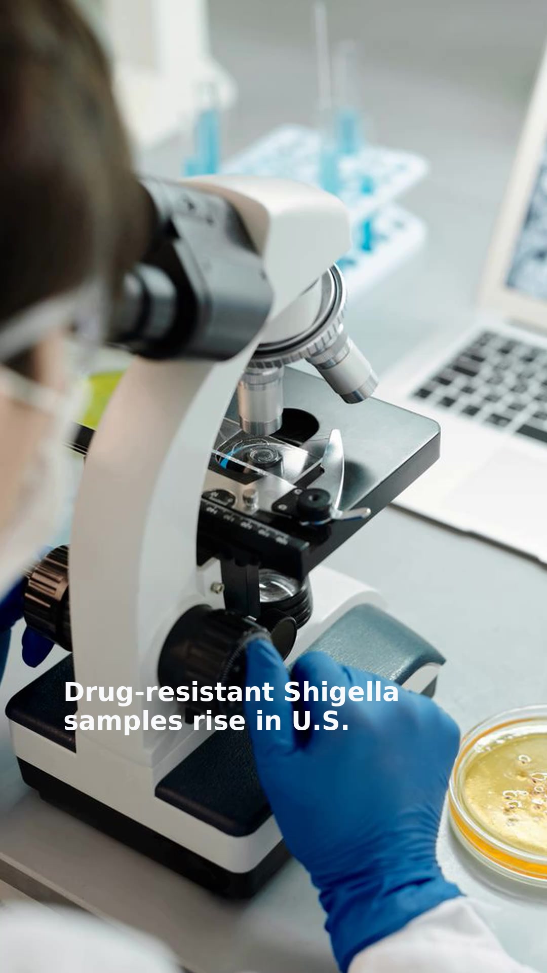 Drug-resistant Shigella samples rise in U.S.