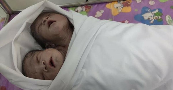 В Мьянме родились сиамские близнецы с общим телом и двумя головами В Мьянме родились сиамские близнецы с общим телом и двумя головами