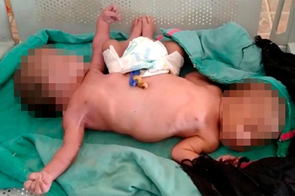 Сиамские близнецы родились с двумя ногами и четырьмя руками Сиамские близнецы родились с двумя ногами и четырьмя руками